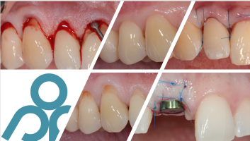 Chirurgie plastique parodontale et péri-implantaire 2024